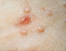 Mulluscum warts on the arm